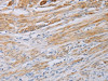 The image on the left is immunohistochemistry of paraffin-embedded Human cervical cancer tissue using CSB-PA590716 (MYL6 Antibody) at dilution 1/40, on the right is treated with fusion protein. (Original magnification: ×200)