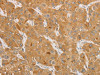 The image is immunohistochemistry of paraffin-embedded Human liver cancer tissue using CSB-PA942456 (NGF Antibody) at dilution 1/50. (Original magnification: ×200)