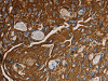 The image on the left is immunohistochemistry of paraffin-embedded Human esophagus cancer tissue using CSB-PA904747 (NRP1 Antibody) at dilution 1/25, on the right is treated with fusion protein. (Original magnification: ×200)
