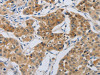 The image on the left is immunohistochemistry of paraffin-embedded Human lung cancer tissue using CSB-PA904747 (NRP1 Antibody) at dilution 1/25, on the right is treated with fusion protein. (Original magnification: ×200)