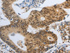 The image on the left is immunohistochemistry of paraffin-embedded Human colon cancer tissue using CSB-PA280193 (POU2F2 Antibody) at dilution 1/40, on the right is treated with fusion protein. (Original magnification: ×200)