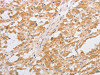 The image on the left is immunohistochemistry of paraffin-embedded Human thyroid cancer tissue using CSB-PA687184 (CDKN2AIP Antibody) at dilution 1/40, on the right is treated with fusion protein. (Original magnification: ×200)