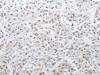 The image on the left is immunohistochemistry of paraffin-embedded Human lung cancer tissue using CSB-PA960924 (DNAJC7 Antibody) at dilution 1/25, on the right is treated with fusion protein. (Original magnification: ×200)