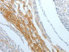 The image on the left is immunohistochemistry of paraffin-embedded Human cervical cancer tissue using CSB-PA967082 (DNAJC10 Antibody) at dilution 1/15, on the right is treated with fusion protein. (Original magnification: ×200)