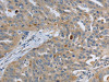 The image on the left is immunohistochemistry of paraffin-embedded Human ovarian cancer tissue using CSB-PA038167 (PAK4 Antibody) at dilution 1/20, on the right is treated with fusion protein. (Original magnification: ×200)