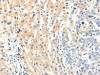 The image on the left is immunohistochemistry of paraffin-embedded Human breast cancer tissue using CSB-PA164310 (PAK7 Antibody) at dilution 1/20, on the right is treated with fusion protein. (Original magnification: ×200)