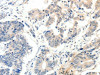 The image on the left is immunohistochemistry of paraffin-embedded Human colon cancer tissue using CSB-PA164310 (PAK7 Antibody) at dilution 1/20, on the right is treated with fusion protein. (Original magnification: ×200)