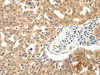 The image on the left is immunohistochemistry of paraffin-embedded Human ovarian cancer tissue using CSB-PA158224 (PAK7 Antibody) at dilution 1/10, on the right is treated with fusion protein. (Original magnification: ×200)
