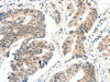 The image on the left is immunohistochemistry of paraffin-embedded Human colon cancer tissue using CSB-PA064607 (FAM3A Antibody) at dilution 1/30, on the right is treated with fusion protein. (Original magnification: ×200)