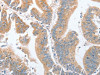 The image on the left is immunohistochemistry of paraffin-embedded Human colon cancer tissue using CSB-PA530130 (PARD6A Antibody) at dilution 1/60, on the right is treated with fusion protein. (Original magnification: ×200)