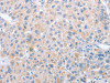 The image on the left is immunohistochemistry of paraffin-embedded Human liver cancer tissue using CSB-PA787971 (PARD6A Antibody) at dilution 1/60, on the right is treated with fusion protein. (Original magnification: ×200)