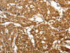 The image on the left is immunohistochemistry of paraffin-embedded Human lung cancer tissue using CSB-PA948689 (PARK7 Antibody) at dilution 1/25, on the right is treated with fusion protein. (Original magnification: ×200)