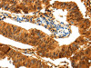 The image on the left is immunohistochemistry of paraffin-embedded Human colon cancer tissue using CSB-PA948689 (PARK7 Antibody) at dilution 1/25, on the right is treated with fusion protein. (Original magnification: ×200)