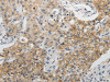 The image on the left is immunohistochemistry of paraffin-embedded Human lung cancer tissue using CSB-PA196946 (CDH3 Antibody) at dilution 1/5, on the right is treated with fusion protein. (Original magnification: ×200)