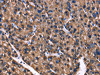 The image on the left is immunohistochemistry of paraffin-embedded Human liver cancer tissue using CSB-PA014587 (PHB Antibody) at dilution 1/40, on the right is treated with fusion protein. (Original magnification: ×200)