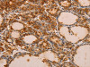 The image on the left is immunohistochemistry of paraffin-embedded Human thyroid cancer tissue using CSB-PA797351 (PIK3R1 Antibody) at dilution 1/30, on the right is treated with fusion protein. (Original magnification: ×200)