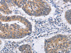 The image on the left is immunohistochemistry of paraffin-embedded Human colon cancer tissue using CSB-PA213853 (RCHY1 Antibody) at dilution 1/30, on the right is treated with fusion protein. (Original magnification: ×200)