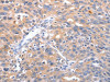 The image on the left is immunohistochemistry of paraffin-embedded Human ovarian cancer tissue using CSB-PA899249 (RCHY1 Antibody) at dilution 1/30, on the right is treated with fusion protein. (Original magnification: ×200)