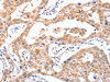 The image on the left is immunohistochemistry of paraffin-embedded Human lung cancer tissue using CSB-PA899249 (RCHY1 Antibody) at dilution 1/30, on the right is treated with fusion protein. (Original magnification: ×200)