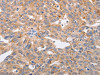 The image on the left is immunohistochemistry of paraffin-embedded Human ovarian cancer tissue using CSB-PA559752 (PPP1CB Antibody) at dilution 1/40, on the right is treated with fusion protein. (Original magnification: ×200)