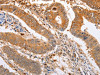 The image on the left is immunohistochemistry of paraffin-embedded Human colon cancer tissue using CSB-PA237602 (SERP1 Antibody) at dilution 1/20, on the right is treated with fusion protein. (Original magnification: ×200)