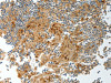 The image on the left is immunohistochemistry of paraffin-embedded Human tonsil tissue using CSB-PA241683 (PRCP Antibody) at dilution 1/20, on the right is treated with fusion protein. (Original magnification: ×200) The image on the left is immunohistochemistry of paraffin-embedded Human tonsil tissue using CSB-PA241683 (PRCP Antibody) at dilution 1/20, on the right is treated with fusion protein. (Original magnification: ×200)