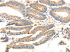 The image on the left is immunohistochemistry of paraffin-embedded Human colon cancer tissue using CSB-PA797558 (PRDX3 Antibody) at dilution 1/20, on the right is treated with fusion protein. (Original magnification: ×200)