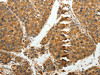 The image on the left is immunohistochemistry of paraffin-embedded Human liver cancer tissue using CSB-PA578648 (RRM1 Antibody) at dilution 1/15, on the right is treated with fusion protein. (Original magnification: ×200)