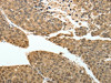 The image on the left is immunohistochemistry of paraffin-embedded Human liver cancer tissue using CSB-PA938686 (PSMD3 Antibody) at dilution 1/30, on the right is treated with fusion protein. (Original magnification: ×200)