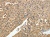 The image on the left is immunohistochemistry of paraffin-embedded Human ovarian cancer tissue using CSB-PA938686 (PSMD3 Antibody) at dilution 1/30, on the right is treated with fusion protein. (Original magnification: ×200)