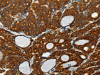 The image on the left is immunohistochemistry of paraffin-embedded Human thyroid cancer tissue using CSB-PA830765 (SELM Antibody) at dilution 1/25, on the right is treated with fusion protein. (Original magnification: ×200)