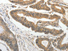 The image on the left is immunohistochemistry of paraffin-embedded Human colon cancer tissue using CSB-PA773563 (SLC4A4 Antibody) at dilution 1/50, on the right is treated with fusion protein. (Original magnification: ×200)