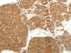 The image on the left is immunohistochemistry of paraffin-embedded Human liver cancer tissue using CSB-PA938450 (SOCS3 Antibody) at dilution 1/20, on the right is treated with fusion protein. (Original magnification: ×200)