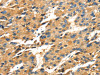 The image on the left is immunohistochemistry of paraffin-embedded Human liver cancer tissue using CSB-PA785325 (SPARC Antibody) at dilution 1/25, on the right is treated with fusion protein. (Original magnification: ×200)