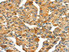 The image on the left is immunohistochemistry of paraffin-embedded Human liver cancer tissue using CSB-PA190682 (SPARC Antibody) at dilution 1/35, on the right is treated with fusion protein. (Original magnification: ×200)