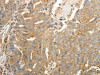 The image on the left is immunohistochemistry of paraffin-embedded Human ovarian cancer tissue using CSB-PA924520 (SFTPD Antibody) at dilution 1/30, on the right is treated with fusion protein. (Original magnification: ×200)