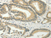 The image on the left is immunohistochemistry of paraffin-embedded Human colon cancer tissue using CSB-PA976302 (SPIN4 Antibody) at dilution 1/20, on the right is treated with fusion protein. (Original magnification: ×200)