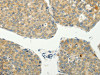 The image on the left is immunohistochemistry of paraffin-embedded Human liver cancer tissue using CSB-PA976302 (SPIN4 Antibody) at dilution 1/20, on the right is treated with fusion protein. (Original magnification: ×200)