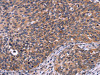 The image on the left is immunohistochemistry of paraffin-embedded Human cervical cancer tissue using CSB-PA503322 (SPATA7 Antibody) at dilution 1/30, on the right is treated with fusion protein. (Original magnification: ×200)