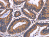 The image on the left is immunohistochemistry of paraffin-embedded Human colon cancer tissue using CSB-PA195430 (SPATA7 Antibody) at dilution 1/30, on the right is treated with fusion protein. (Original magnification: ×200)