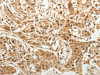 The image on the left is immunohistochemistry of paraffin-embedded Human lung cancer tissue using CSB-PA208349 (SPATA17 Antibody) at dilution 1/25, on the right is treated with fusion protein. (Original magnification: ×200)