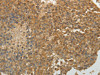 The image on the left is immunohistochemistry of paraffin-embedded Human liver cancer tissue using CSB-PA124064 (SULT1E1 Antibody) at dilution 1/30, on the right is treated with fusion protein. (Original magnification: ×200)