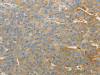 The image on the left is immunohistochemistry of paraffin-embedded Human ovarian cancer tissue using CSB-PA124064 (SULT1E1 Antibody) at dilution 1/30, on the right is treated with fusion protein. (Original magnification: ×200)