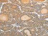 The image on the left is immunohistochemistry of paraffin-embedded Human thyroid cancer tissue using CSB-PA265957 (MAP4 Antibody) at dilution 1/10, on the right is treated with fusion protein. (Original magnification: ×200)