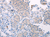 The image on the left is immunohistochemistry of paraffin-embedded Human lung cancer tissue using CSB-PA096932 (TEKT4 Antibody) at dilution 1/10, on the right is treated with fusion protein. (Original magnification: ×200)