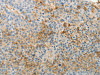 The image on the left is immunohistochemistry of paraffin-embedded Human liver cancer tissue using CSB-PA827458 (TIMP1 Antibody) at dilution 1/15, on the right is treated with fusion protein. (Original magnification: ×200)