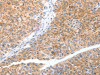 The image on the left is immunohistochemistry of paraffin-embedded Human liver cancer tissue using CSB-PA110146 (TRAF3IP3 Antibody) at dilution 1/20, on the right is treated with fusion protein. (Original magnification: ×200)