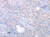 The image on the left is immunohistochemistry of paraffin-embedded Human cervical cancer tissue using CSB-PA956978 (TRIM32 Antibody) at dilution 1/25, on the right is treated with fusion protein. (Original magnification: ×200) The image on the left is immunohistochemistry of paraffin-embedded Human cervical cancer tissue using CSB-PA956978 (TRIM32 Antibody) at dilution 1/25, on the right is treated with fusion protein. (Original magnification: ×200)