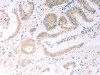 The image on the left is immunohistochemistry of paraffin-embedded Human colon cancer tissue using CSB-PA956978 (TRIM32 Antibody) at dilution 1/25, on the right is treated with fusion protein. (Original magnification: ×200) The image on the left is immunohistochemistry of paraffin-embedded Human colon cancer tissue using CSB-PA956978 (TRIM32 Antibody) at dilution 1/25, on the right is treated with fusion protein. (Original magnification: ×200)