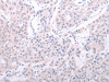 The image on the left is immunohistochemistry of paraffin-embedded Human lung cancer tissue using CSB-PA210868 (SPATA6 Antibody) at dilution 1/40, on the right is treated with fusion protein. (Original magnification: ×200)